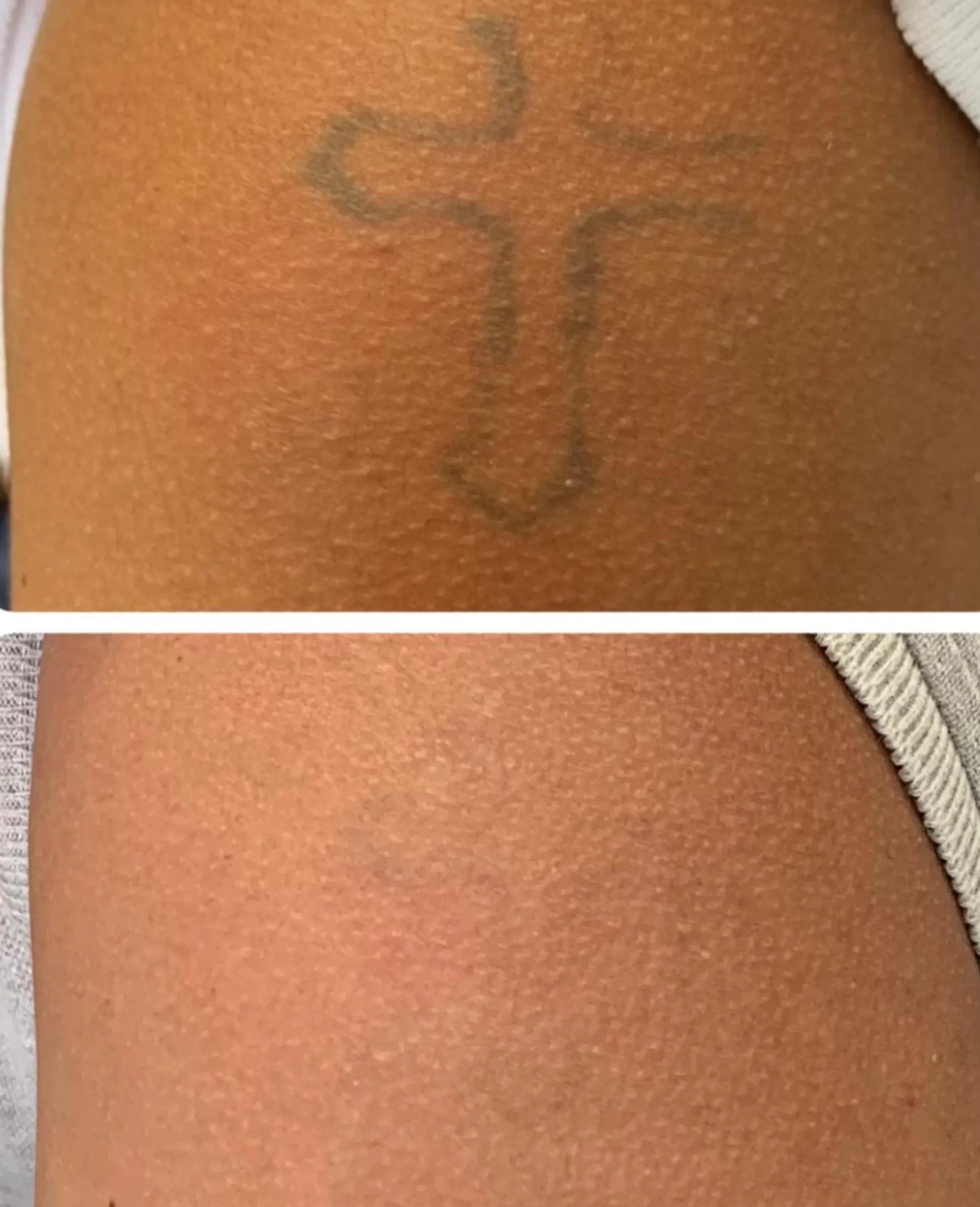 how much is laser tattoo removal