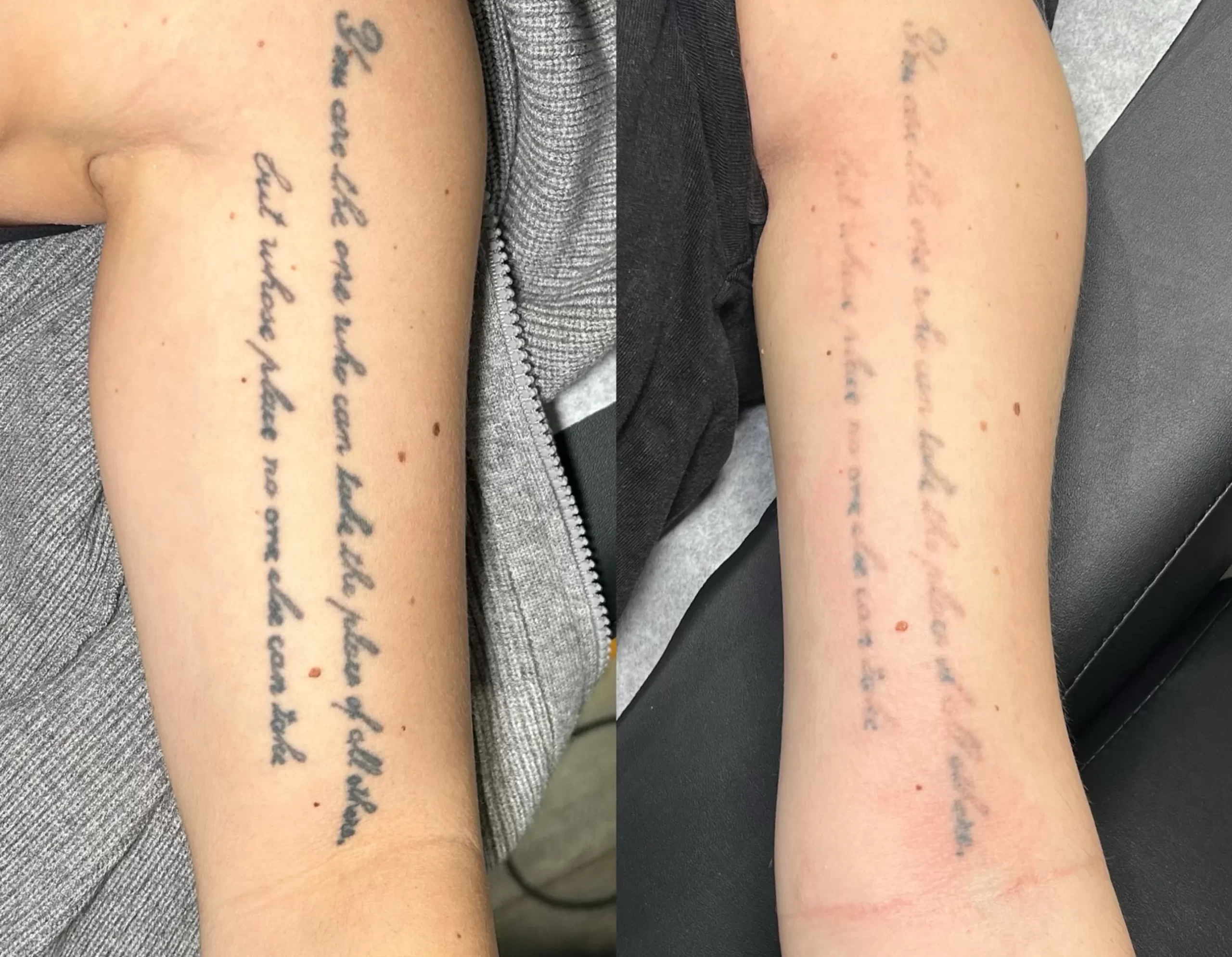 laser removal tattoo