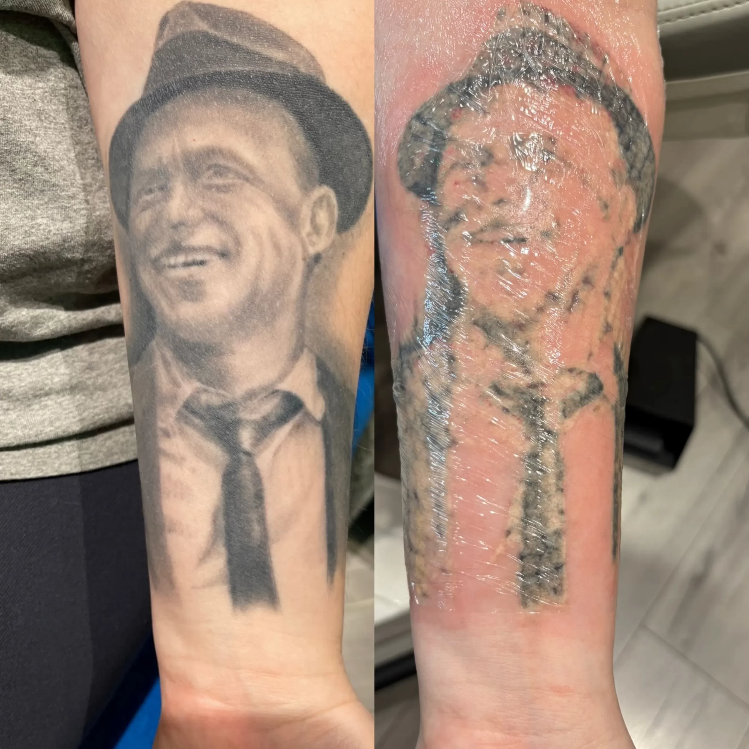 laser tattoo removal cost