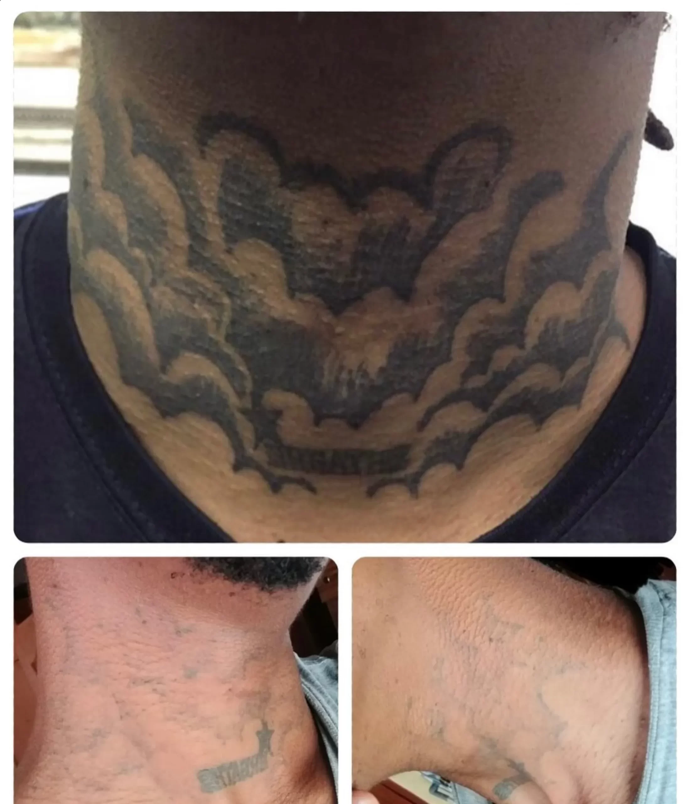laser tattoo removal melbourne