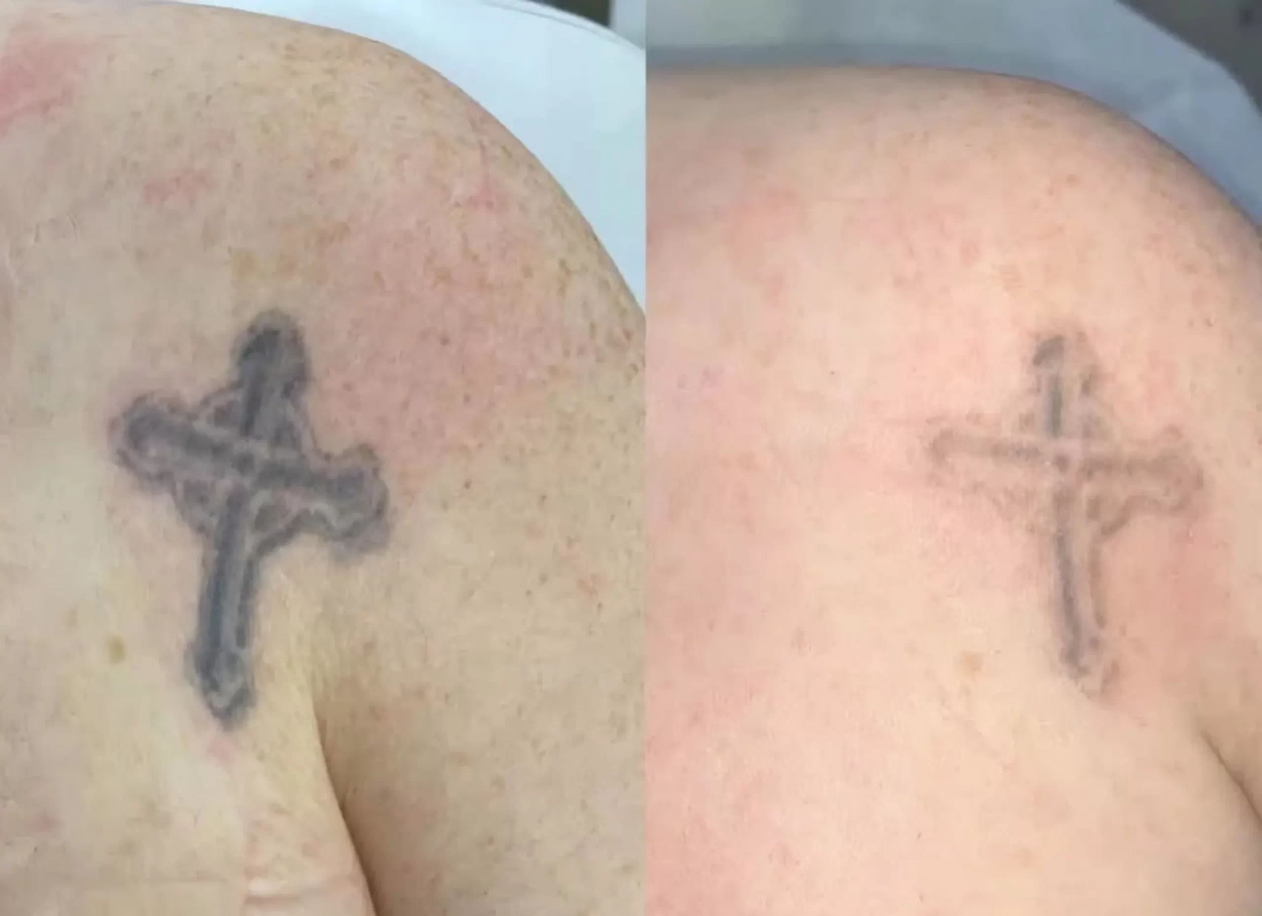tattoo laser removal near me
